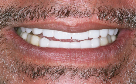 image of teeth after treatment