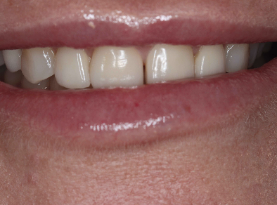 image of teeth before treatment