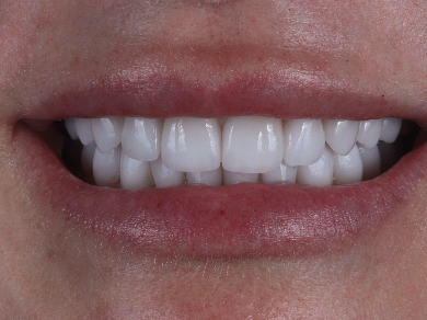 image of teeth after treatment
