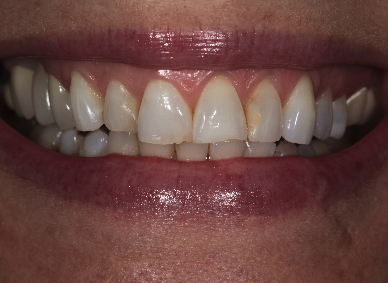 image of teeth before treatment