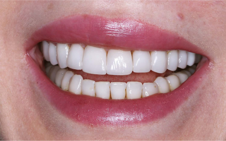 image of teeth before treatment