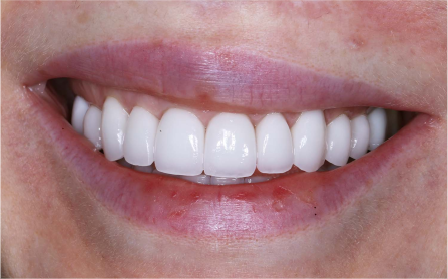 image of teeth after treatment