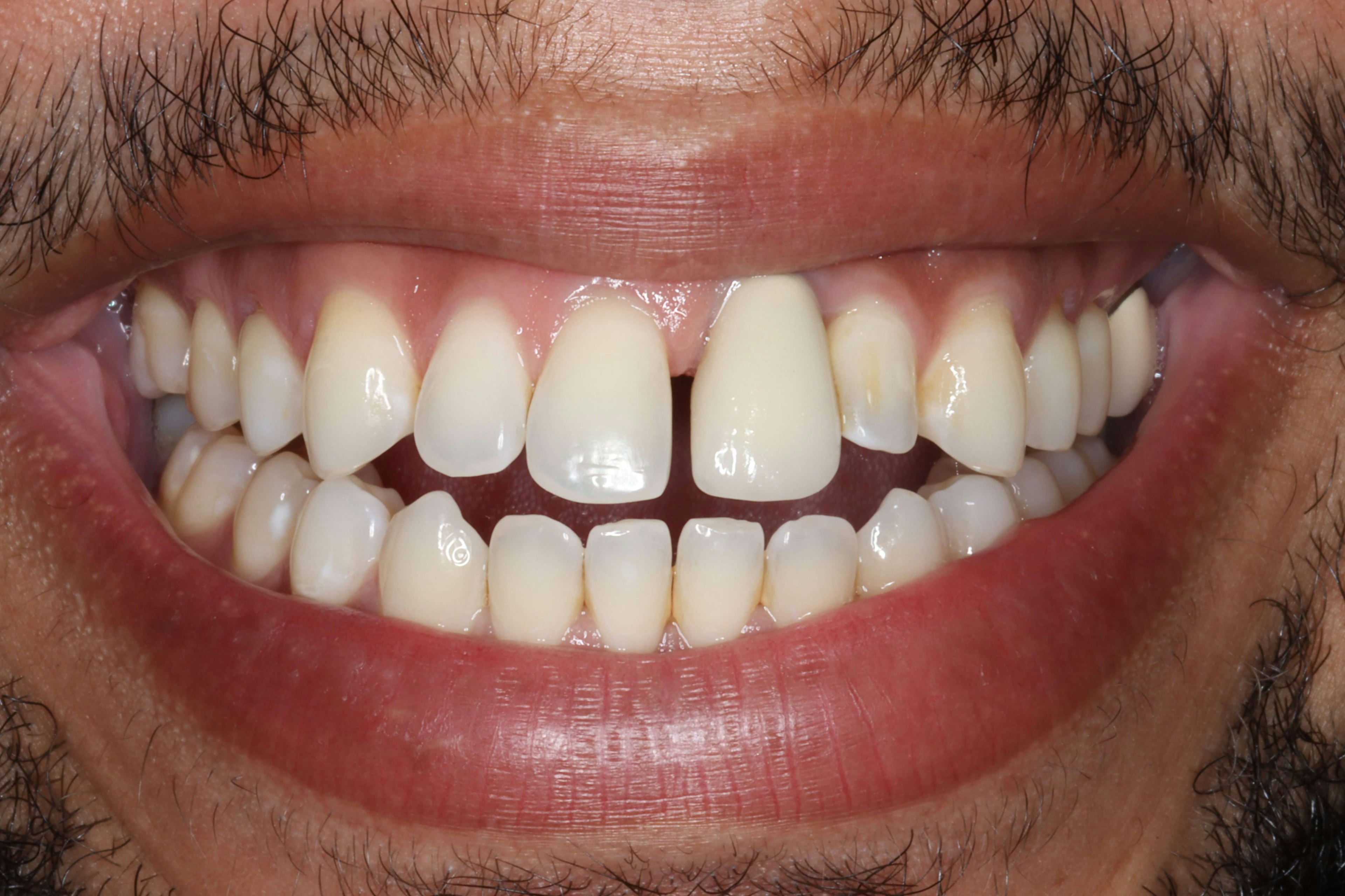 image of teeth before treatment