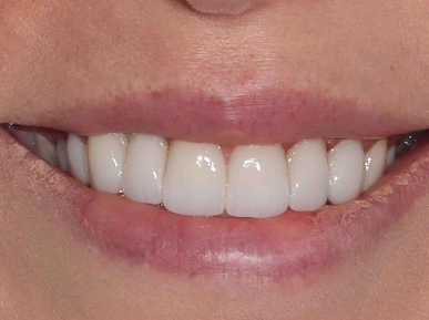 image of teeth after treatment