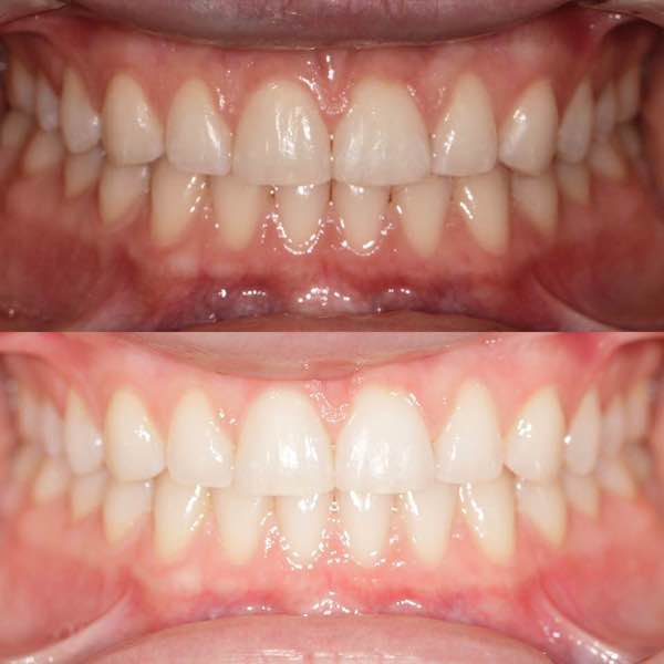 before and after teeth whitening