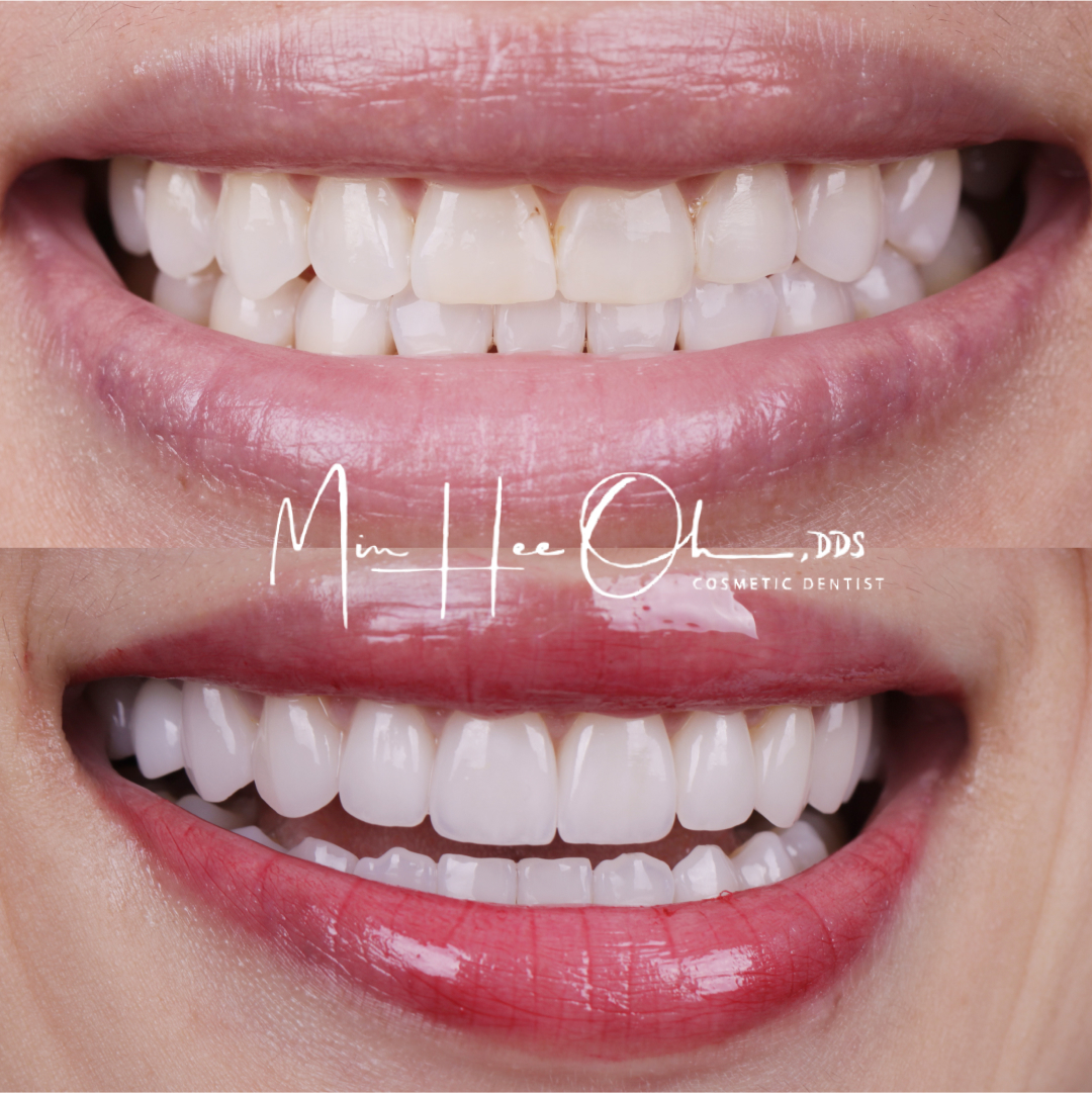 LA patient before and after veneers