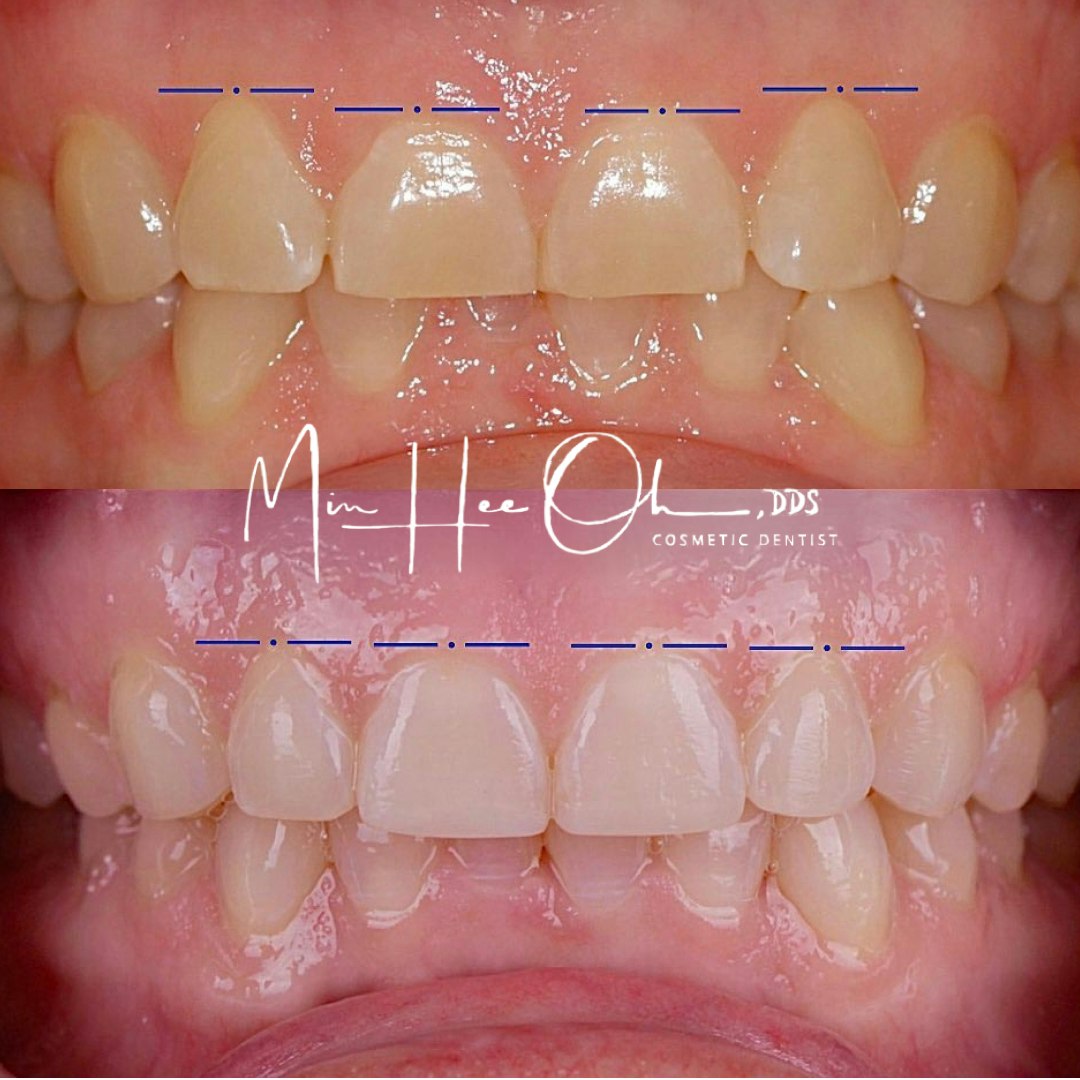 Dr. Oh's patient before and after bonding