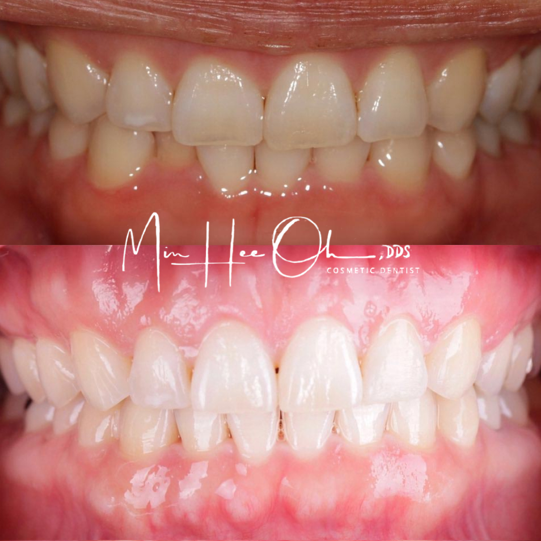 Dr. Oh's patient before and after teeth whitening