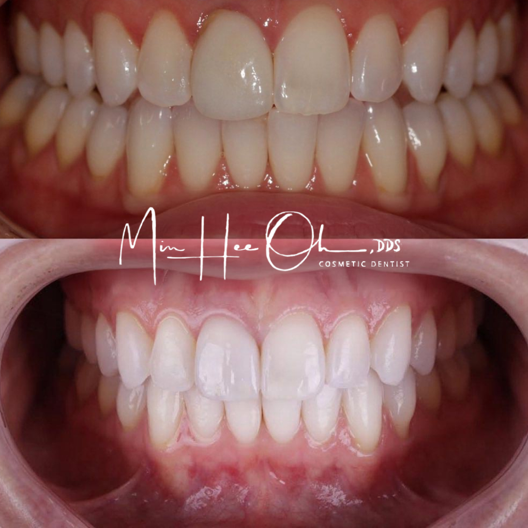 Dr. Oh's patient before and after crowns