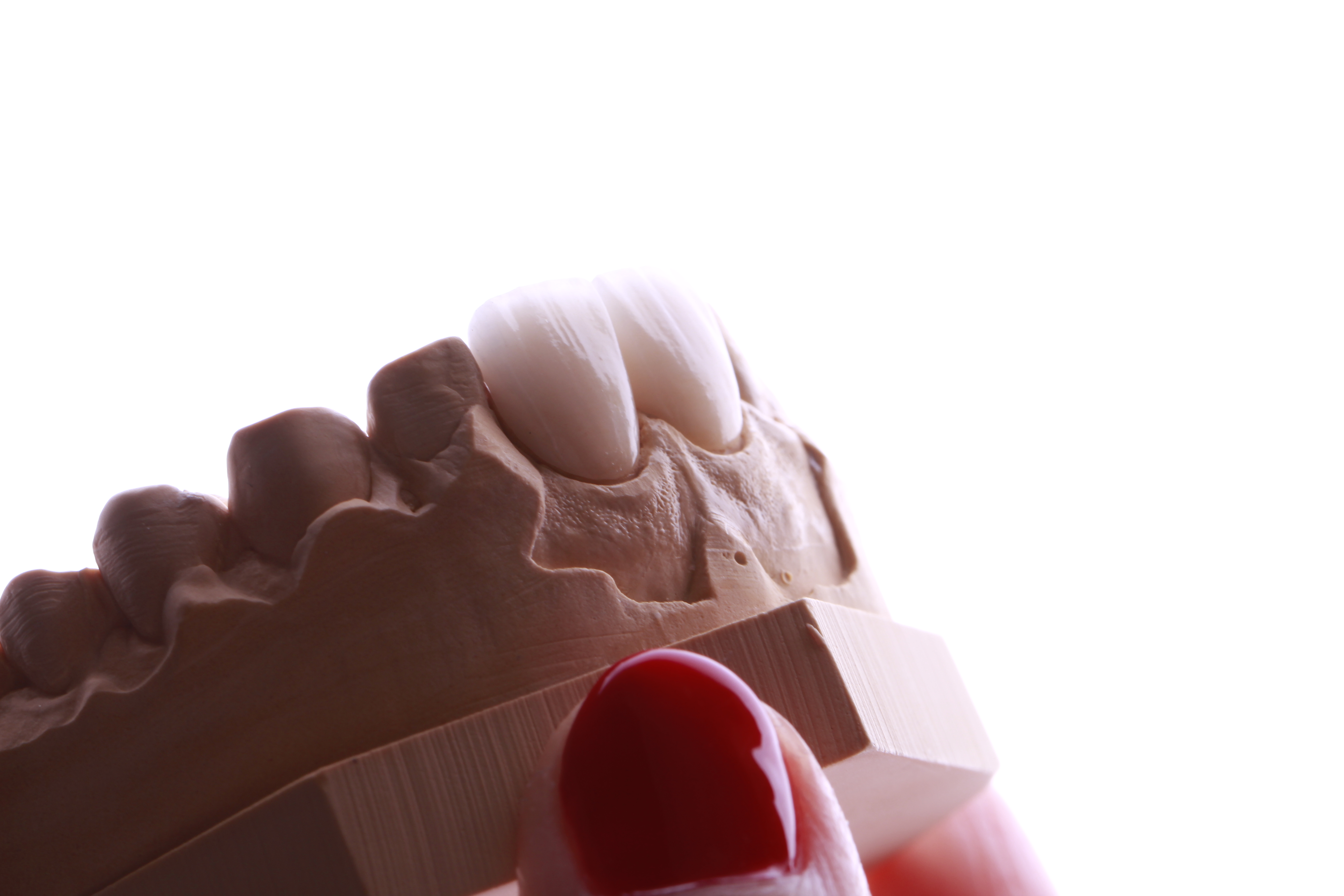 veneers in a model dental arch