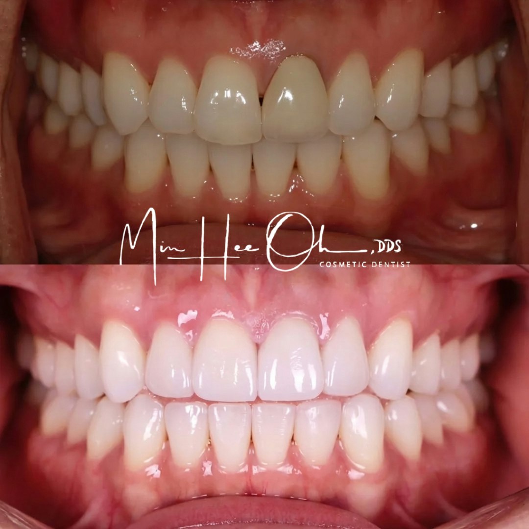 LA patient before and after treatment