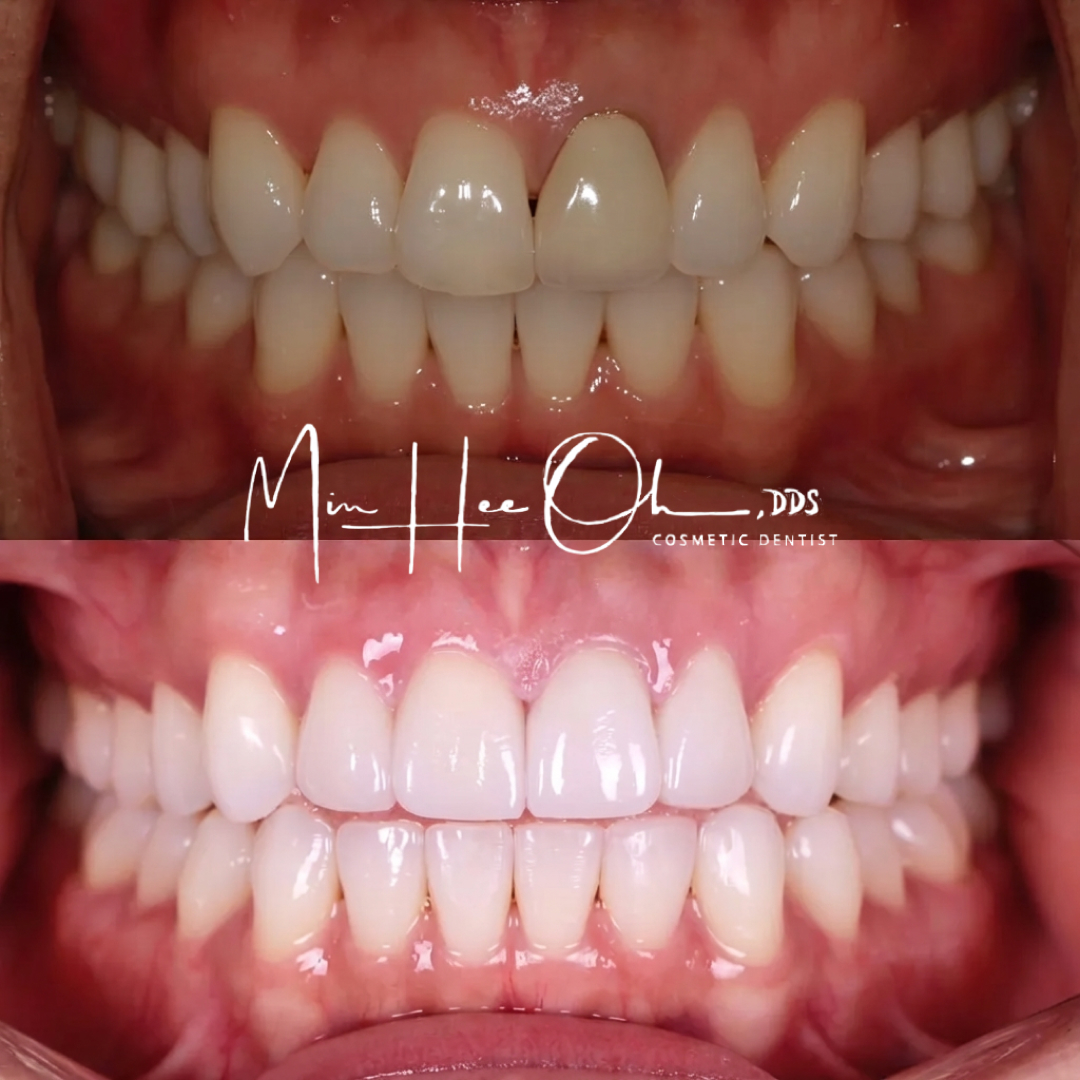 LA patient before and after treatment