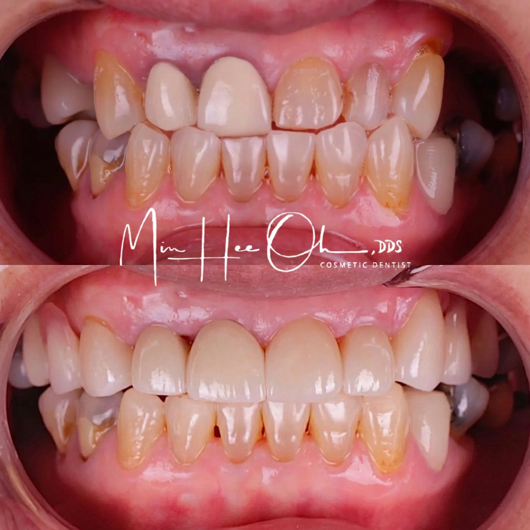 LA patient before and after treatment