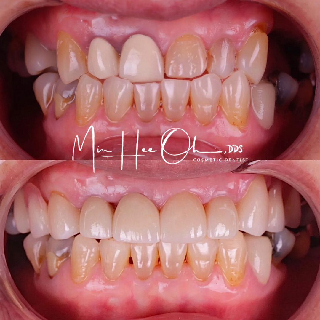 LA patient before and after treatment