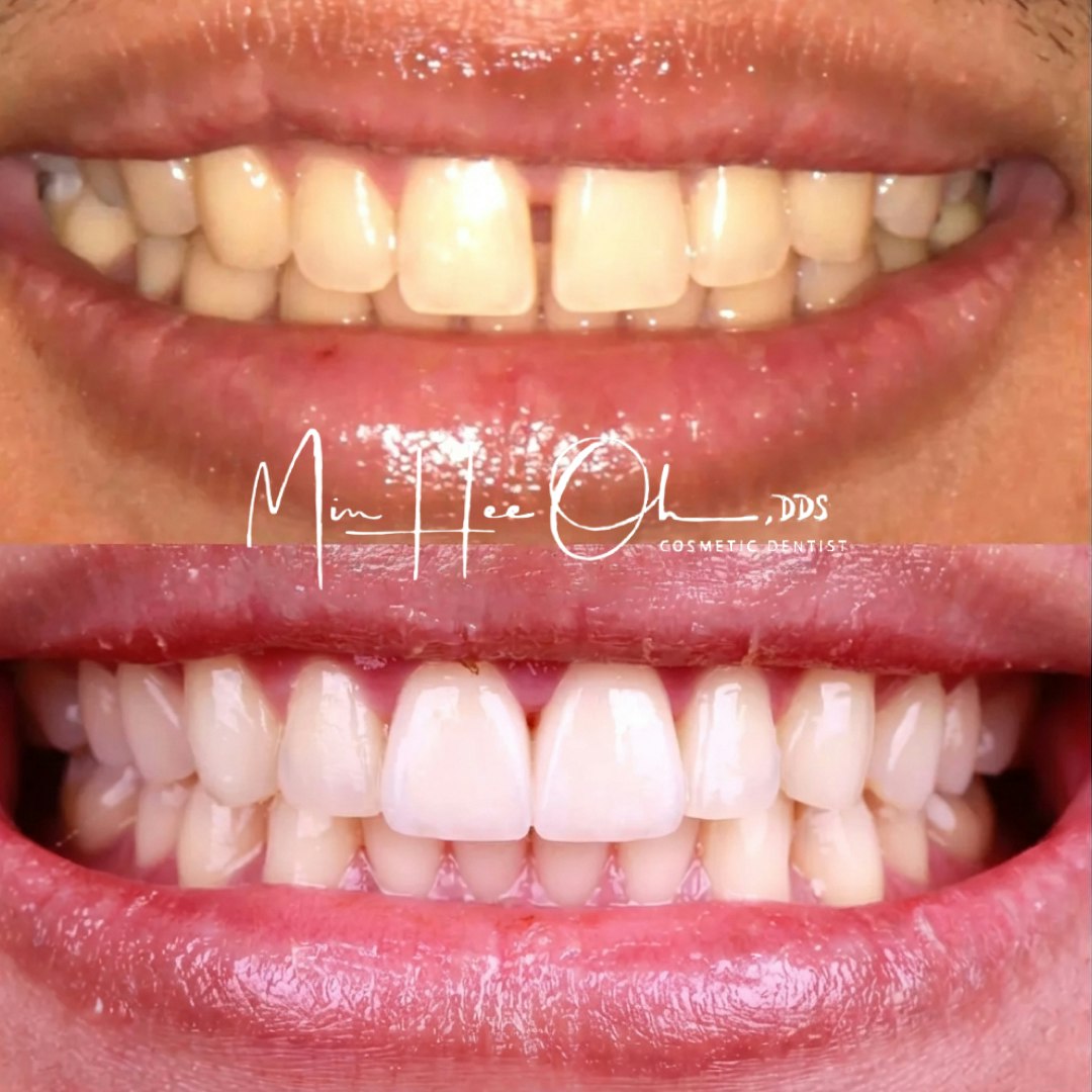 LA patient before and after treatment