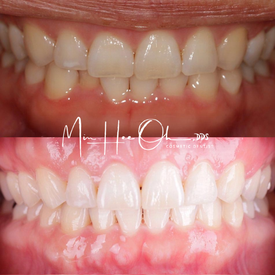 LA patient before and after teeth whitening