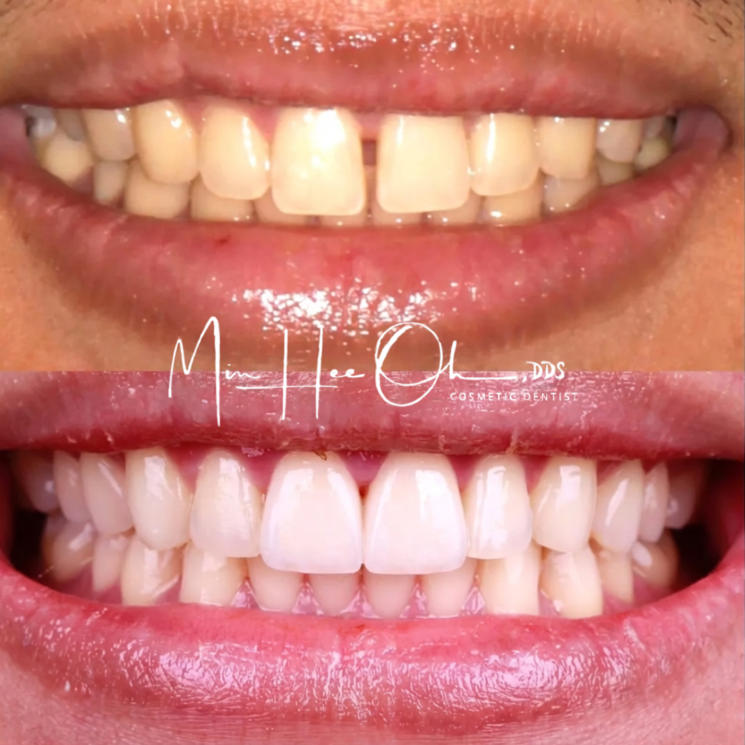 LA patient before and after Invisalign
