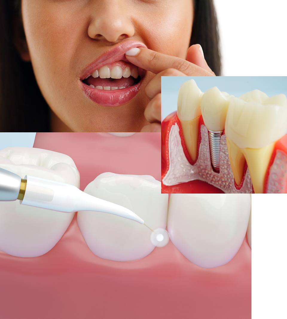 Woman looking at gums, implant in jaw, and LAPIP procedure