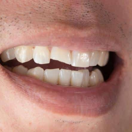 chipped tooth