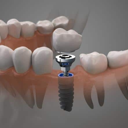 dental implant illustration
