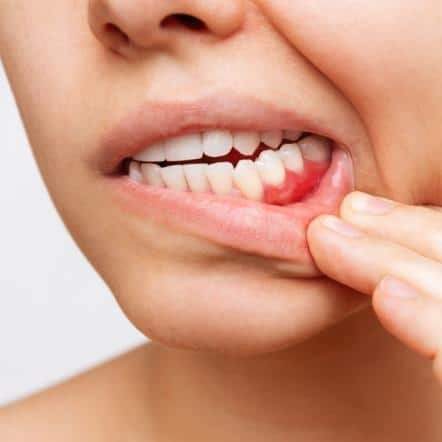inflamed gum tissue
