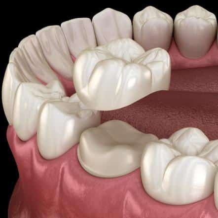 dental crown illustration
