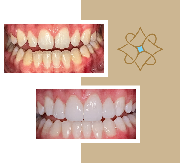 Patient teeth before and after veneers
