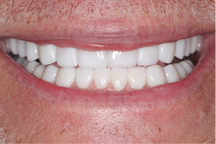Smile of a client after treatment