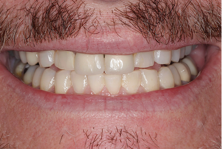 Smile of a client before treatment