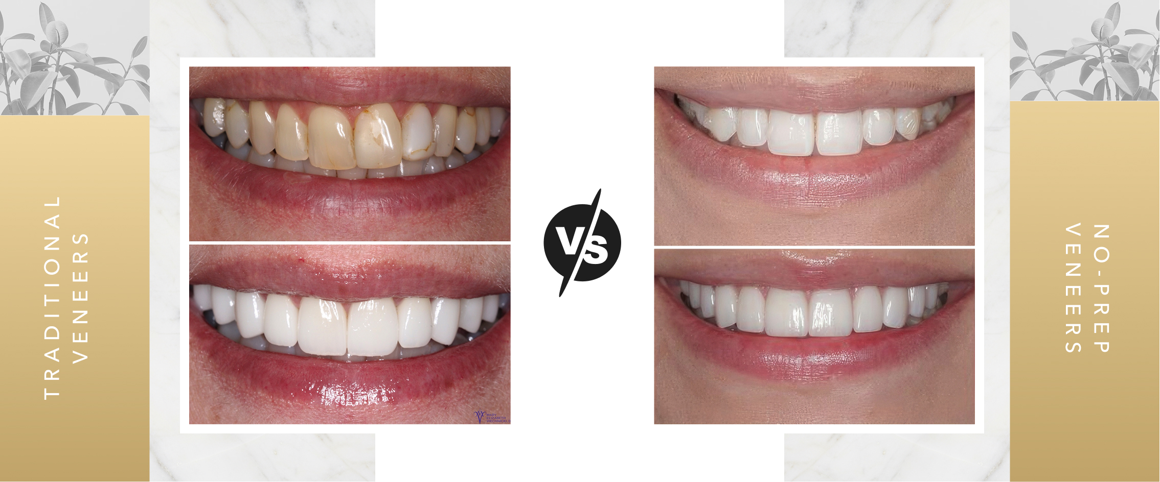 Veneer before & after results