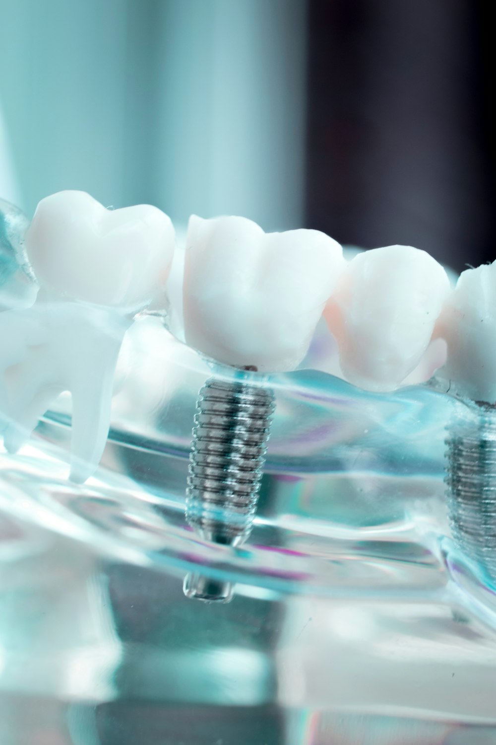 image of implant model