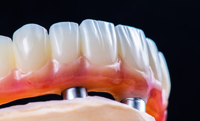 implant denture