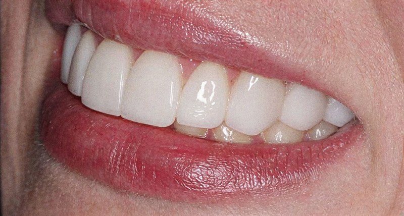 After veneers