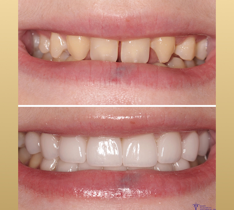 no prep veneer results