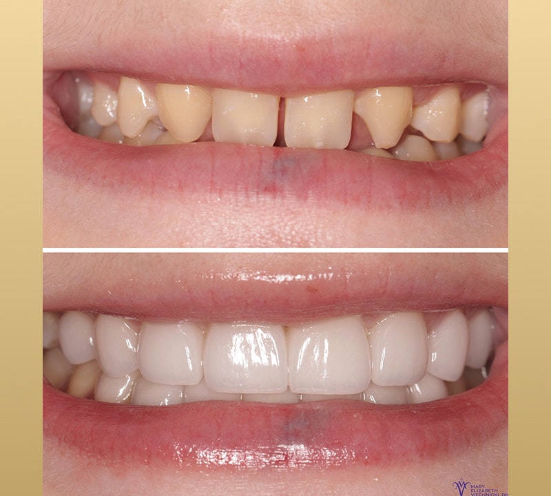 No-prep veneers patient