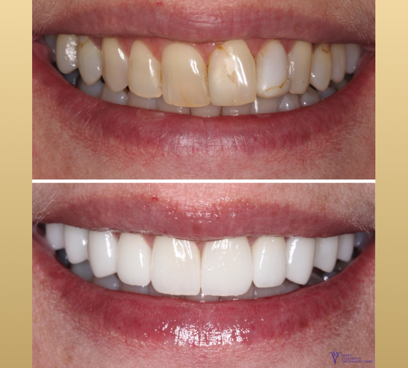 traditional veneers results