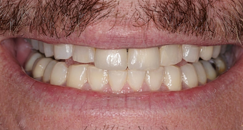 Allentown patient before smile makeover