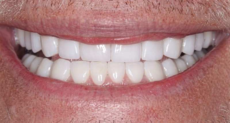 Allentown patient after smile makeover