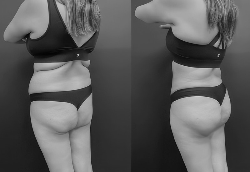 a San Diego BBL patient