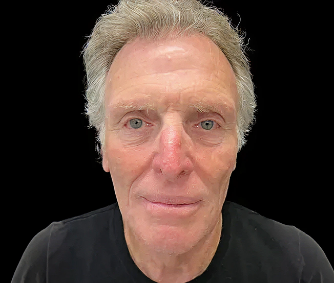 Front-facing view of an older man with visible under-eye bags and sagging skin beneath the lower eyelids prior to lower blepharoplasty.