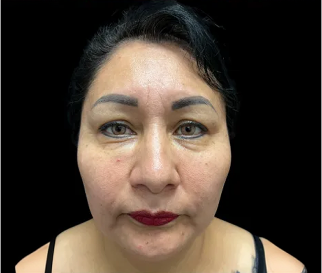 Front-facing view of a woman with visible under-eye bags and puffiness prior to lower blepharoplasty.