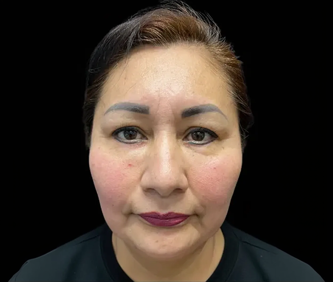 Front-facing view of the same woman after lower blepharoplasty, showing smoother under-eye contours and a more youthful appearance.