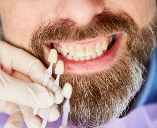 Person getting shade matched for teeth whitening