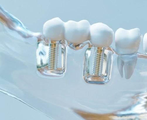 dental implants