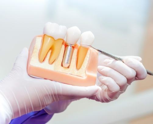 dental implants
