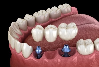 dental bridge