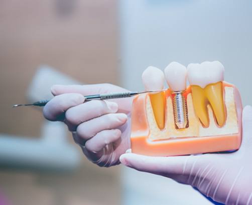 dental implants