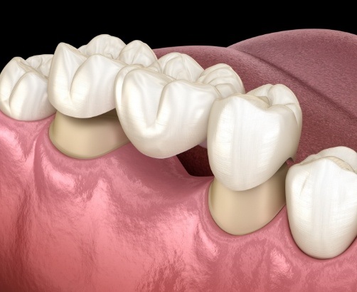 Dental bridge