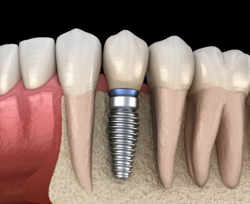 dental implants