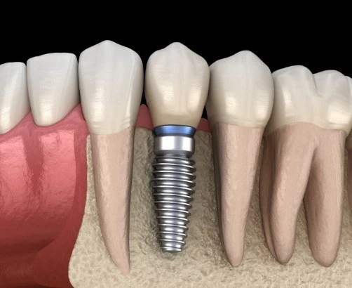dental implants